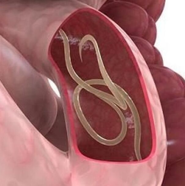Znakovi crva u osobi u gastrointestinalnom traktu